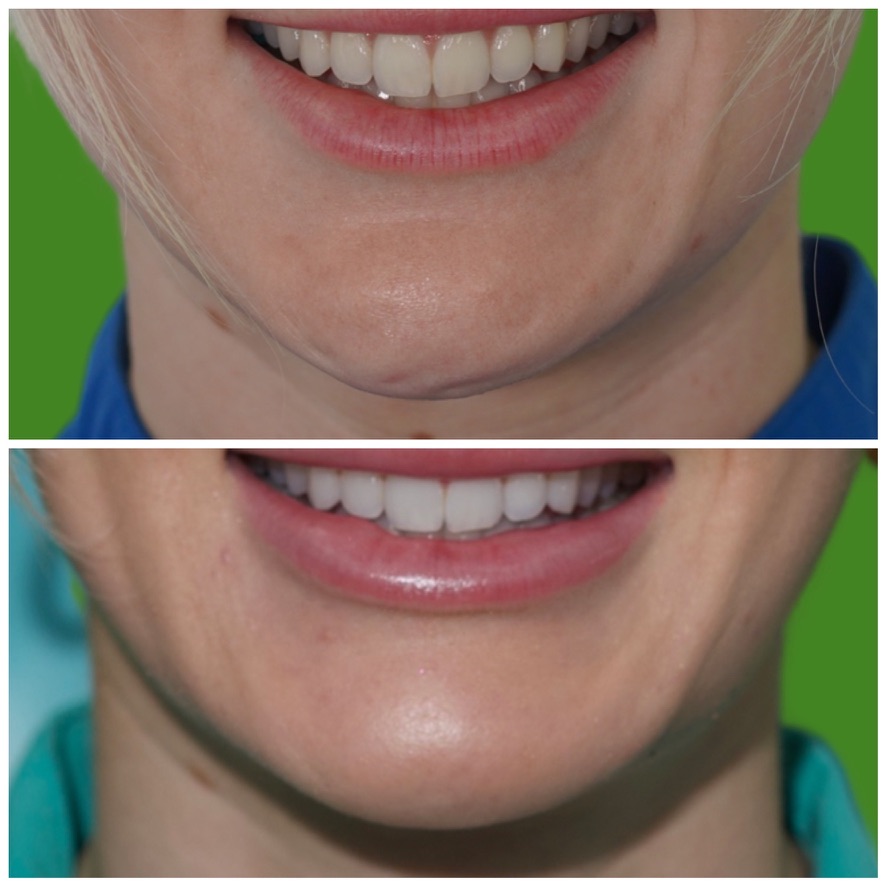 Smiling before and after lip filler results showing a fuller upper lip and better tooth show after treatment at Petro Facial Plastic Surgery