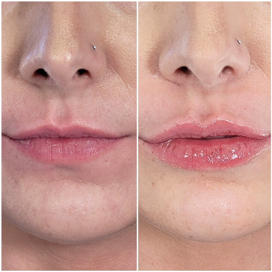 Before and after dermal filler restoring lip volume and softening smoker's lines around the mouth in a mature patient in Birmingham, AL