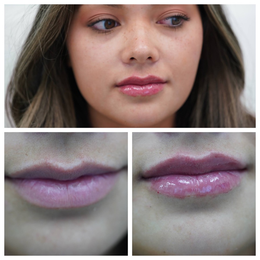 Before and after lip filler on a young woman showing a fuller, glossier lip with a defined cupid's bow, treated by Dr. Melanie Petro in Vestavia Hills, Alabama
