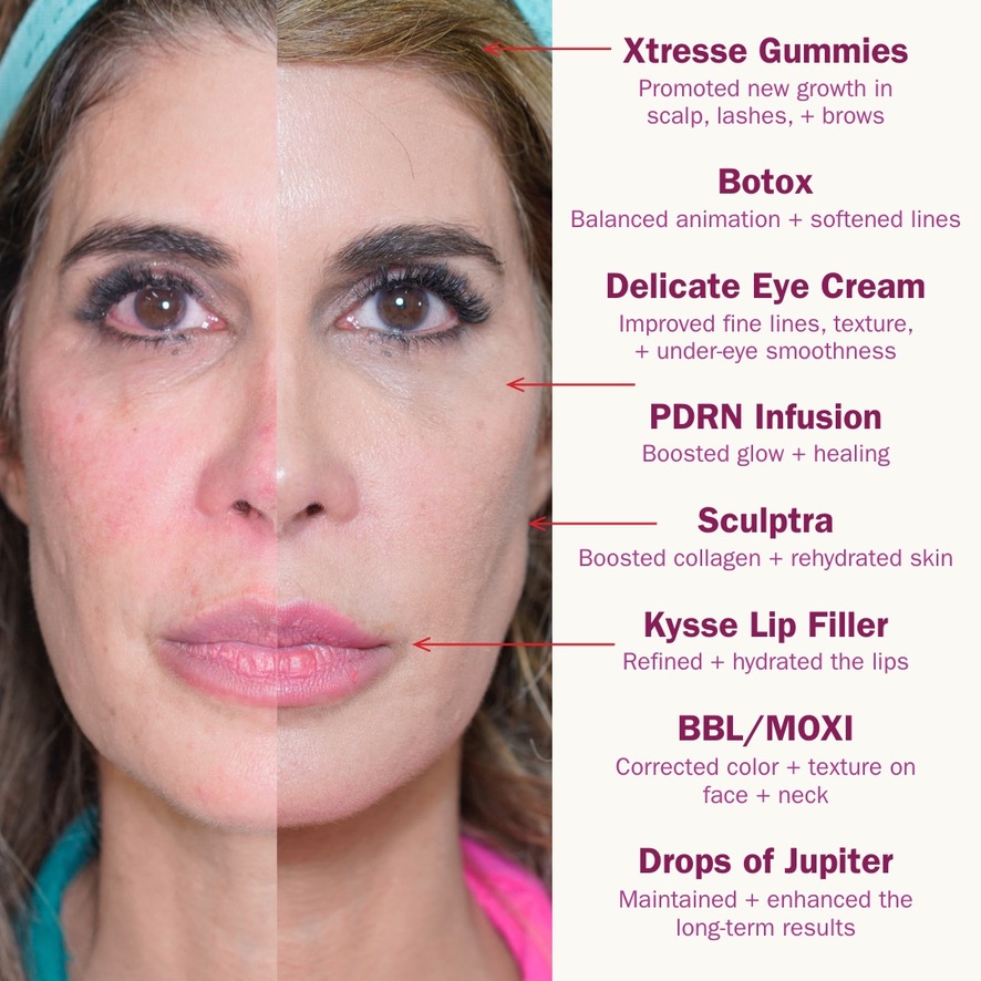 Full-face before and after results labeled by treatment: Botox for balanced animation, Sculptra for collagen, Restylane Kysse lip filler, BBL and MOXI for color and texture, PDRN infusion for glow