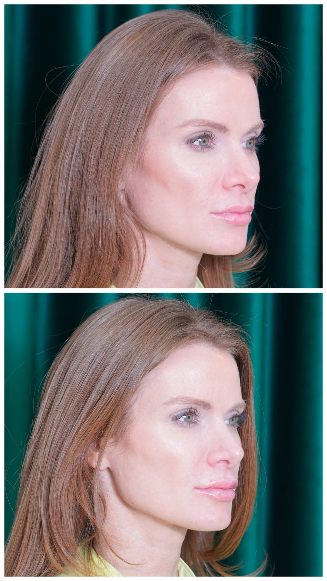 Three-quarter view before and after lip filler: subtle projection and lip volume added by Dr. Melanie Petro, Vestavia Hills AL