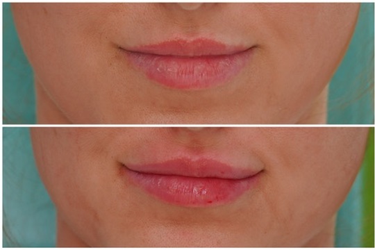Before and after lip filler close-up showing symmetric, natural lip enhancement in a patient of Dr. Melanie Petro in Vestavia Hills, AL