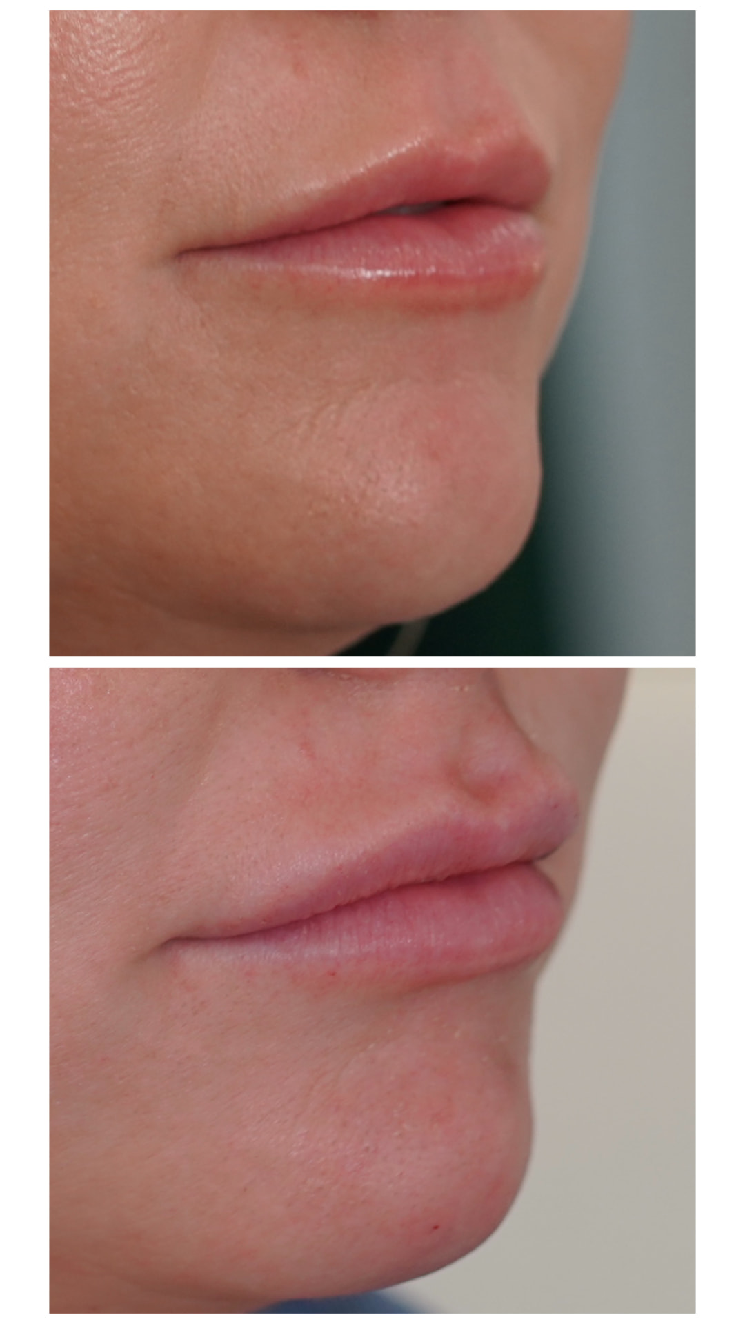 Oblique view before and after lip filler with improved lip border and fullness, Vestavia Hills AL