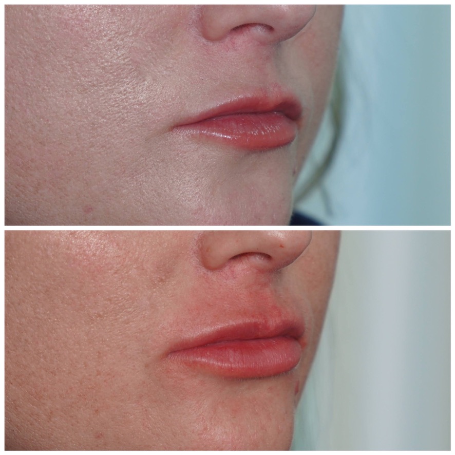 Three-quarter view before and after lip filler showing improved lip projection and vermilion border in Birmingham, Alabama