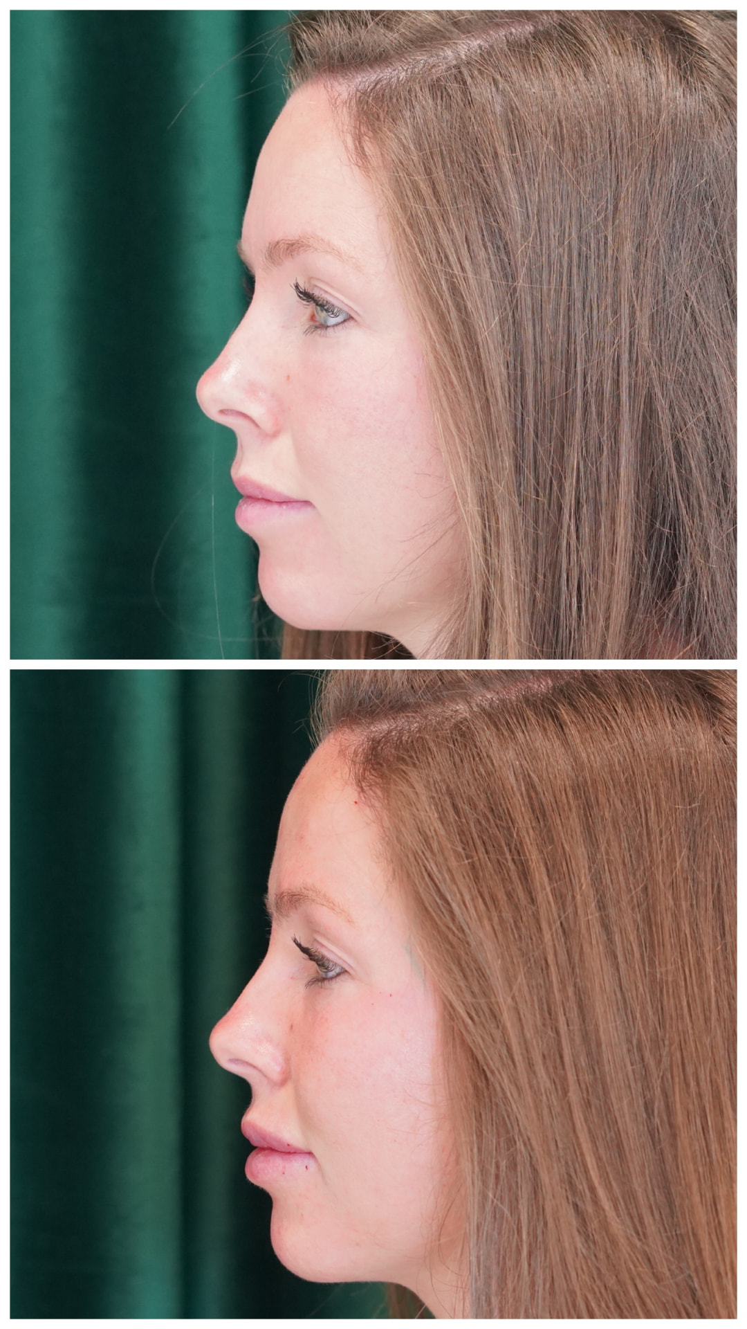 Side profile before and after lip filler showing restored upper lip projection, Birmingham AL