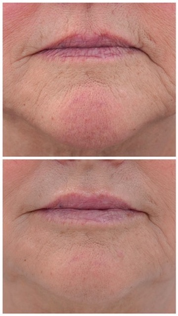 Before and after dermal filler treatment of perioral lip lines and chin creasing in a mature patient at Petro Facial Plastic Surgery, Birmingham AL