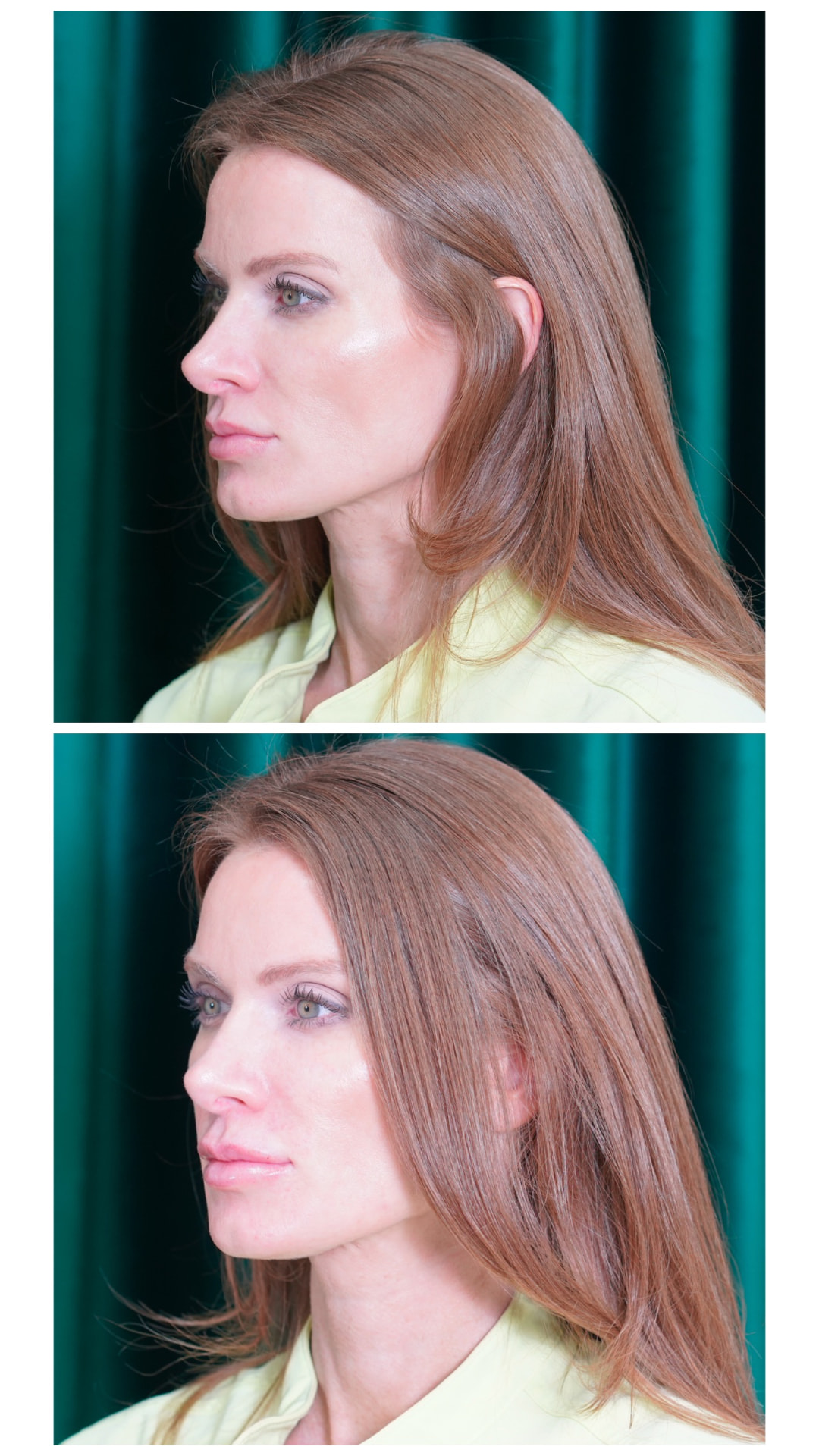 Profile view before and after lip filler showing improved lip projection and balance, Petro Facial Plastic Surgery Birmingham AL