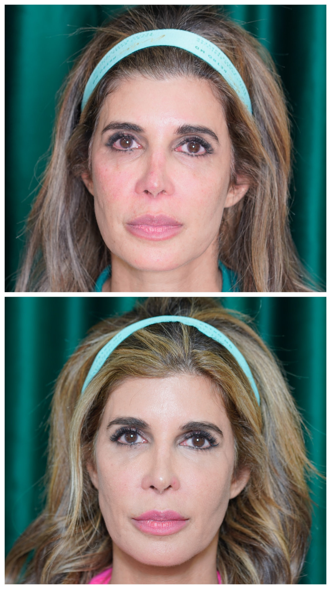 Before and after lip filler in Birmingham AL: top photo shows thin, less defined lips; bottom photo shows fuller, balanced lips with a defined border after one syringe with Dr. Melanie Petro
