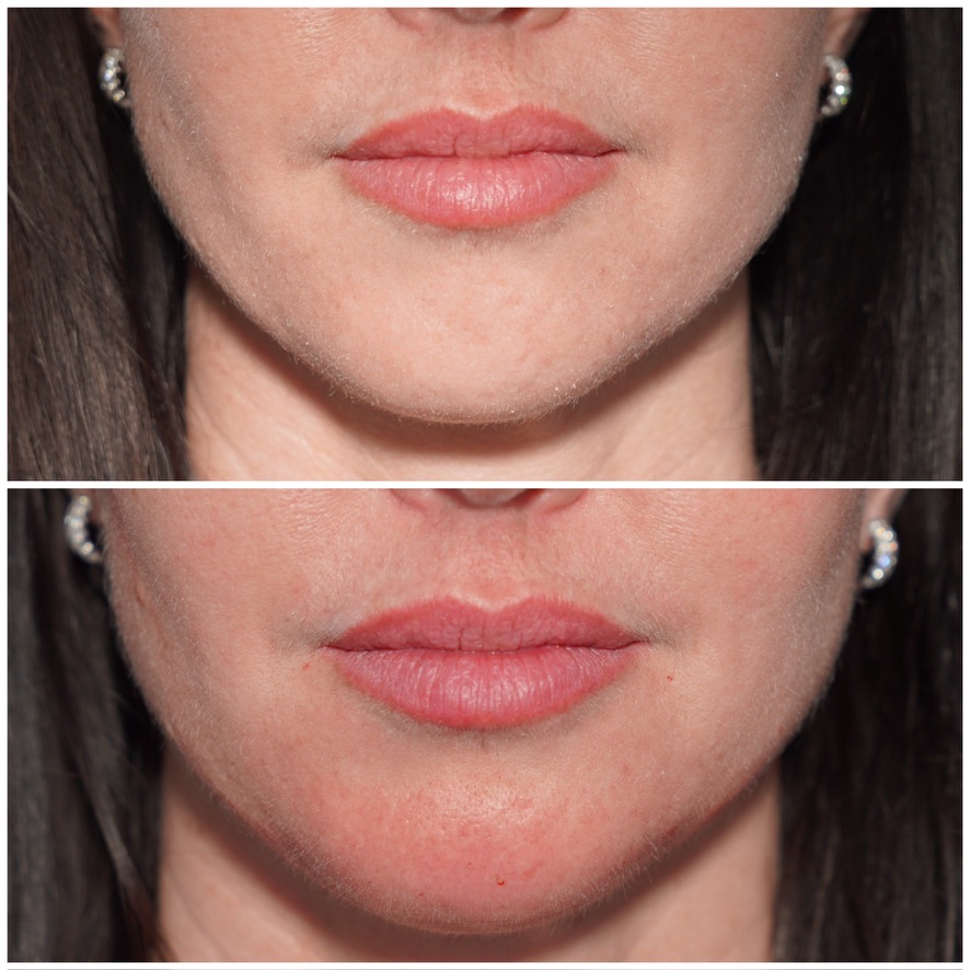 Before and after lip filler photo showing improved lip proportion and definition in a dark-haired patient treated in Birmingham, Alabama