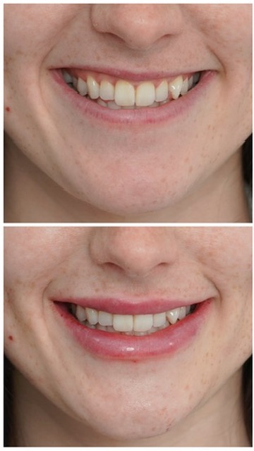 Before and after lip filler on a smiling patient showing a fuller, well-shaped upper lip treated at Petro Facial Plastic Surgery, Vestavia Hills