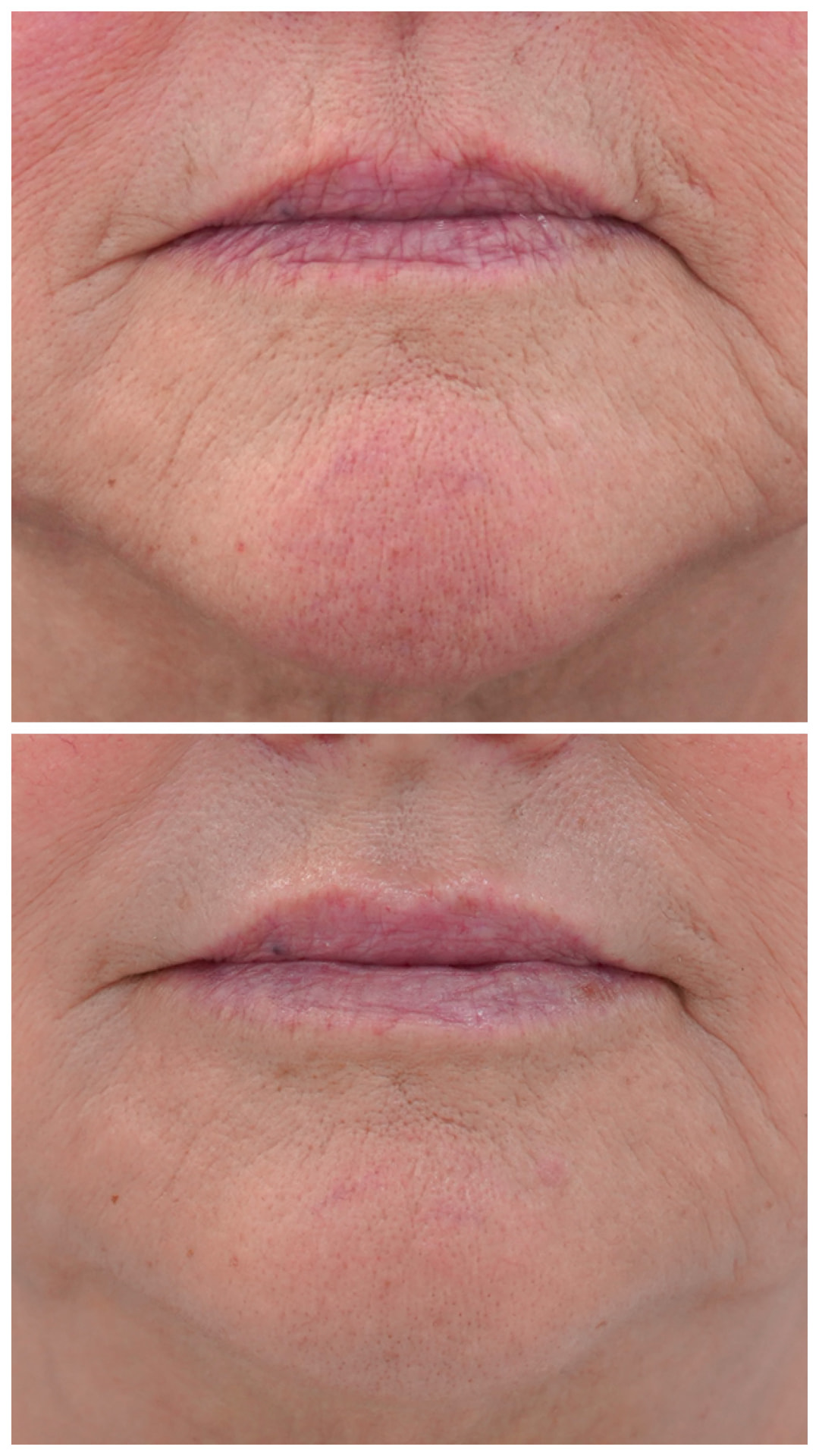 Mature lips before and after filler: vertical lip lines softened and volume restored by Dr. Melanie Petro in Birmingham AL