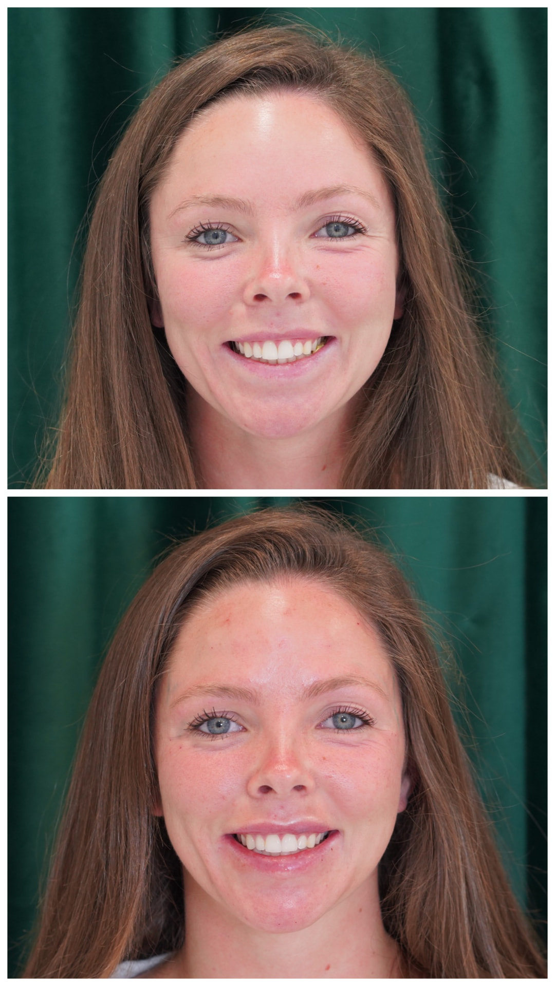 Full-face before and after lip filler showing a more balanced smile after treatment with Dr. Melanie Petro