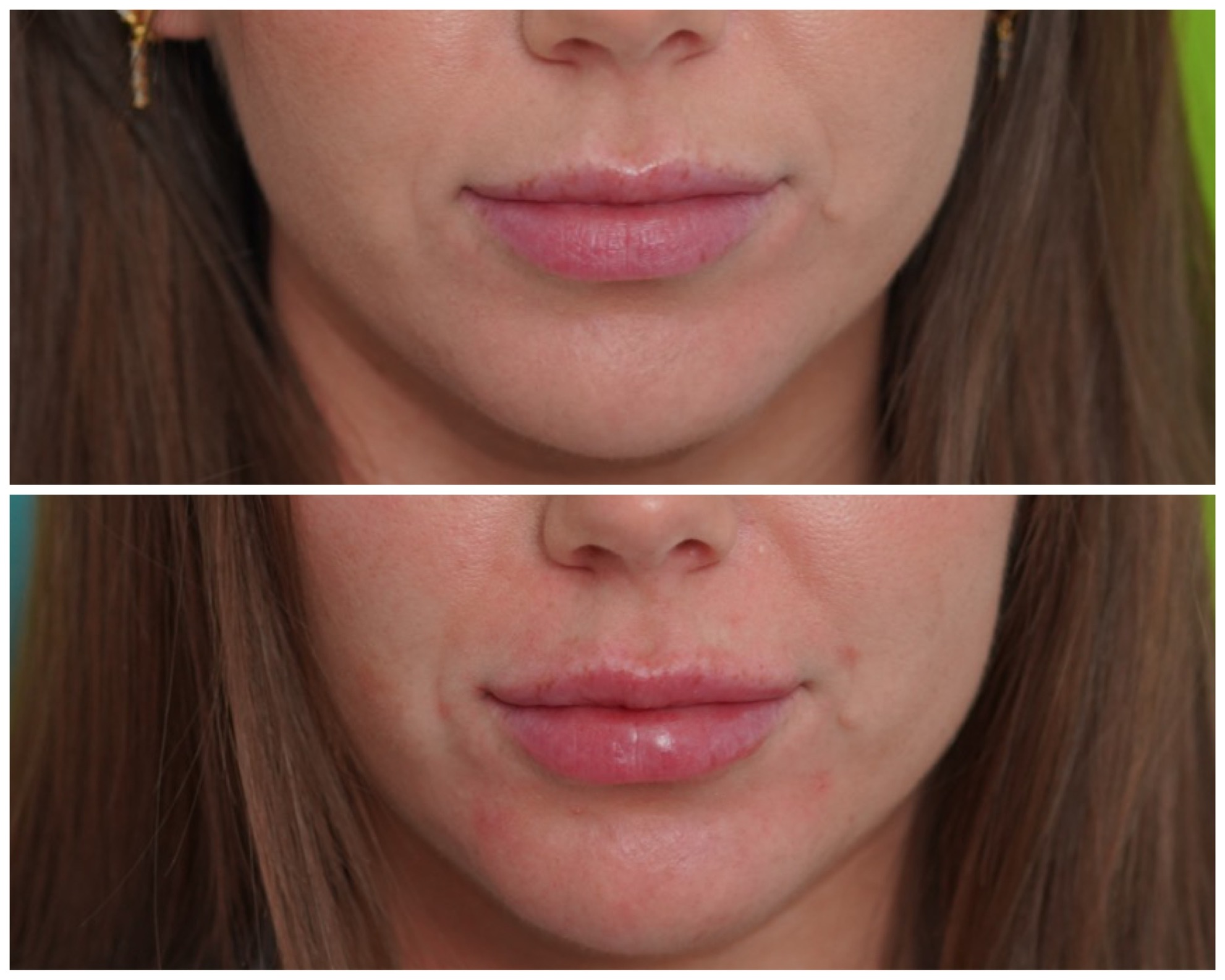 Before and after lip filler results showing a subtly fuller, more defined upper and lower lip on a young woman treated by Dr. Melanie Petro in Birmingham, Alabama
