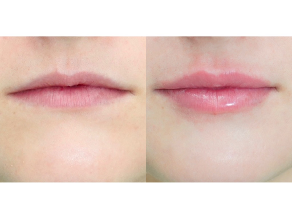 Side by side lip filler before and after photo showing improved lip shape, hydration and a defined vermilion border after treatment in Vestavia Hills, AL