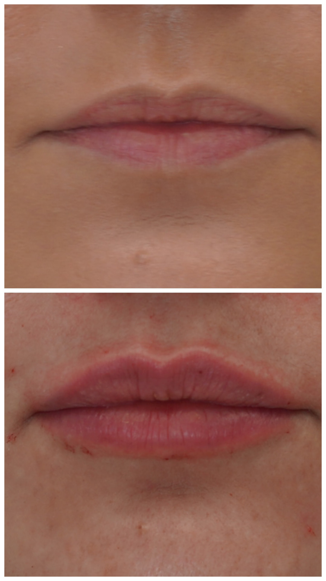 Lip filler before and after front view: flatter upper lip before, defined Cupid's bow and fuller balanced lips after treatment with Dr. Melanie Petro in Vestavia Hills AL